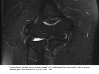 Tendinopatia crônica do comum do extensores ("epicondilite lateral") em paciente de 39 anos, do sexo feminino, praticante de musculação, com dor há 1 ano.