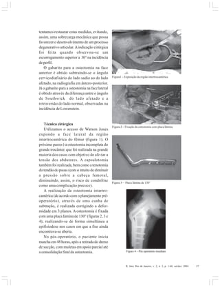R. Into, Rio de Janeiro, v. 2, n. 3, p. 1-60, set/dez. 2004 27
tentamos restaurar estas medidas, evitando,
assim, uma sobrecarga mecânica que possa
favorecer o desenvolvimento de um processo
degenerativo articular.Aindicação cirúrgica
foi feita quando observou-se um
escorregamento superior a 30° na incidência
de perfil.
O gabarito para a osteotomia na face
anterior é obtido subtraindo-se o ângulo
cervicodiafisário do lado sadio ao do lado
afetado, na radiografia em ântero-posterior.
Já o gabarito para a osteotomia na face lateral
é obtido através da diferença entre o ângulo
de Southwick do lado afetado e a
retroversão do lado normal, observadas na
incidência de Lowenstein.
Técnica cirúrgica
Utilizamos o acesso de Watson Jones
expondo a face lateral da região
intertrocantérica do fêmur (figura 1). O
próximo passo é a osteotomia incompleta do
grande trocânter, que foi realizada na grande
maioría dos casos com objetivo de aliviar a
tensão dos abdutores. A capsulotomia
também foi realizada, bem como a tenotomia
do tendão do psoas (com o intuito de diminuir
a pressão sobre a cabeça femoral,
diminuindo, assim, o risco de condrólise
como uma complicação precoce).
A realização da osteotomia intertro-
cantérica (de acordo com o planejamento pré-
operatório), através de uma cunha de
subtração, é realizada corrigindo a defor-
midade em 3 planos. A osteotomia é fixada
com uma placa lâmina de 130° (figuras 2, 3 e
4), realizando-se de forma simultânea a
epifisiodese nos casos em que a fise ainda
encontrava-se aberta.
No pós-operatório, o paciente inicia
marcha em 48 horas, após a retirada do dreno
de sucção, com muletas em apoio parcial até
a consolidação final da osteotomia.
Figura1 – Exposição da região intertrocantérica
Figura 4 – Pós operatório imediato
Figura 3 – Placa lâmina de 130°
Figura 2 – Fixação da osteotomia com placa lâmina
 