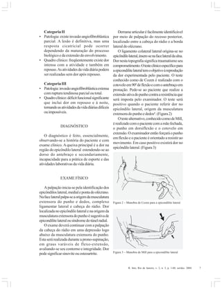 R. Into, Rio de Janeiro, v. 2, n. 3, p. 1-60, set/dez. 2004 7
Categoria II
• Patologia:existeinvasãoangiofibroblástica
parcial. A lesão é definitiva, mas uma
resposta cicatricial pode ocorrer
dependendo da maturação do processo
biológicoedaextensãodoenvolvimento.
• Quadro clínico: freqüentemente existe dor
intensa com a atividade e também em
repouso.Asatividadesdavidadiáriapodem
ser realizadas sem dor após repouso.
Categoria III
• Patologia:invasãoangiofibroblásticaextensa
com ruptura tendinosa parcial ou total.
• Quadroclínico:déficitfuncionalsignificante
que inclui dor em repouso e à noite,
tornandoasatividadesdavidadiáriasdifíceis
ouimpossíveis.
DIAGNÓSTICO
O diagnóstico é feito, essencialmente,
observando-se a história do paciente e com
exame clínico. Aqueixa principal é a dor na
região do epicôndilo lateral estendendo-se ao
dorso do antebraço e secundariamente,
incapacidade para a prática de esporte e das
atividadeslaborativasdavidadiária.
EXAME FÍSICO
A palpação inicia-se pela identificação dos
epicôndiloslateral,medialepontadoolécrano.
Nafacelateralpalpa-seaorigemdamusculatura
extensora do punho e dedos, complexo
ligamentar lateral e cabeça do rádio. Dor
localizadanoepicôndilolateralenaorigemda
musculaturaextensoradopunhoésugestivade
epicondilitelateralousíndromedotúnelradial.
O exame deverá continuar com a palpação
da cabeça do rádio em uma depressão logo
abaixo da musculatura extensora do punho.
Estaserárealizadaduranteaprono-supinação,
em graus varáveis de flexo-extensão,
avaliando-se seu contorno e integridade. Dor
podesignificarsinoviteouosteoartrite.
Derramearticularéfacilmenteidentificável
por meio de palpação do recesso posterior,
localizado entre a cabeça do rádio e a borda
lateral do olécrano.
O ligamento colateral lateral origina-se no
epicôndilolateral,insere-senafacelateraldaulna.
Dornestatopografiasignificatraumatismoseu
comprometimento.Otesteclínicoespecíficopara
aepicondilitelateraltemoobjetivoàreprodução
da dor experimentada pelo paciente. O teste
conhecido como de Cozen é realizado com o
cotoveloem90ºdeflexãoecomoantebraçoem
pronação. Pede-se ao paciente que realize a
extensãoativadopunhocontraaresistênciaque
será imposta pelo examinador. O teste será
positivo quando o paciente referir dor no
epicôndilo lateral, origem da musculatura
extensoradopunhoededos8
.(Figura2)
Otestealternativo,conhecidocomodeMill,
érealizadocomopacientecomamãofechada,
o punho em dorsiflexão e o cotovelo em
extensão.Oexaminadorentãoforçaráopunho
em flexão e o paciente é orientado a resistir ao
movimento. Em caso positivo existirá dor no
epicôndilolateral.(Figura3)
Figura 3 – Manobra de Mill para a epicondilite lateral
Figura 2 – Manobra de Cozen para a epicondilite lateral
 