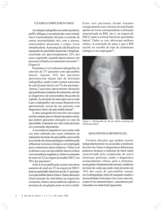 8 R. Into, Rio de Janeiro, v. 2, n. 3, p. 1-60, set/dez. 2004
EXAMES COMPLEMENTARES
Aavaliaçãoradiográficaemantero-posterior,
perfileoblíquas,énamaioriadasvezesnormal,
mas é essencialmente útil para a exclusão de
outras anormalidades tais com a artrose,
osteocondrite dissecante e corpos livres
intraarticulares.Apresençadecalcificaçõesna
topografiadoepicôndilolateralnãoéfreqüente,
ocorrendo em aproximadamente 22% dos
casos, sugerindo, segundo alguns autores, um
processo refratário ao tratamento incruento7,9
.
(Figura4)
Pomerance et al avaliaram radiografias do
cotovelo de 271 pacientes com epicondilite
lateral. Apenas 16% dos pacientes
apresentavam algum tipo de alteração
radiográfica, sendo a mais comum a presença
de calcificação lateral, em 7% dos pacientes.
Apenas 2 pacientes apresentaram alterações
quejustificarammudançadetratamento,devido
ao diagnostico de osteocondrite dissecante do
capítulo.Aconclusãodoautorapósestarevisão
é que a radiografia é um exame dispensável na
apresentação inicial de um paciente com
diagnosticoclinicodeepicondilitelateral10
.
Aultra-sonografiadocotoveloéumexame
auxiliarsimplesparaavaliaçãodaspartesmoles,
que podem apresentar alterações no caso da
epicondilite.Entretantoseuvalorédiscutívelpor
serexaminadordependente.
Aressonânciamagnéticaéumexamecada
vez mais utilizado nos casos refratários ao
tratamentoincruentodaepicondilite,poisauxilia
naexclusãodeoutraspatologiasetambémpode
influenciarnatécnicacirúrgicaaserempregada
para o tratamento desta tendinose. Potter et al
avaliaramcasosdeepicondilitelateralcrônica
comressonânciamagnéticaeobservouaumento
desinalemT2naorigemdotendãoERCCem
50% dos pacientes11
.
Aokietalempublicaçãorecenteencontrou
aumento de sinal em T2 na origem do ERCC
juntoaoepicôndilolateralemseisde11pacientes
comepicondilitelateralcrônica.Outrasalterações
foram aumento de sinal difuso na origem dos
extensores,fraturaosteocondraldocapituloea
presença de um gânglio junto ao nervo radial.
Estes seis pacientes foram tratados
cirurgicamente com a técnica de enucleação
apenas do local correspondente à alteração
caracterizada na RM, isto é, na origem do
ERCC junto a cortical lateral do epicôndilo
lateral. Todos os seis obtiveram melhora
clinica. A conclusão do autor é que a RM
auxilia na escolha do tipo de tratamento
cirúrgico a ser empregado12
.
DIAGNÓSTICODIFERENCIAL
Existem afecções que podem ocorrer
independentemente ou associadas a tendinose
docotovelo.Entreosdiagnósticosdiferenciais
podemos destacar a síndrome do túnel radial
caracterizada pela compressão do nervo
interosseo posterior, sendo o diagnóstico
essencialmente clínico, pois a eletroneu-
romiografiaéfreqüentementenormal,asíndrome
do túnel do carpo que pode estar presente em
10% dos casos de epicondilite lateral,
cervicobraquialgia,lesãodomanguitorotadore
anormalidades articulares tais como sinovite,
corposlivresintraarticulares,osteoartrosepós-
traumáticaouaindalesãoligamentar.
Figura 4 – Radiografia em AP que ilustra a presença de
calcificação lateral
 