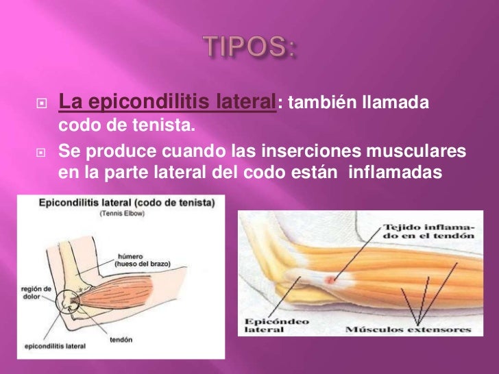 Epicondilitis Grado 2 Grado De Minusvalía Epicondilitis