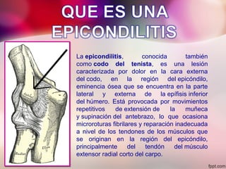 La epicondilitis, conocida también
como codo del tenista, es una lesión
caracterizada por dolor en la cara externa
del codo, en la región del epicóndilo,
eminencia ósea que se encuentra en la parte
lateral y externa de la epífisis inferior
del húmero. Está provocada por movimientos
repetitivos de extensión de la muñeca
y supinación del antebrazo, lo que ocasiona
microroturas fibrilares y reparación inadecuada
a nivel de los tendones de los músculos que
se originan en la región del epicóndilo,
principalmente del tendón del músculo
extensor radial corto del carpo.
 