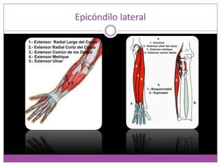Epicondilitis lateral o codo de tenista, Definición:
 Afectación de la zona de inserción de los
músculos epicondíleos lat...
