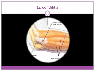 Epicondilitis
 