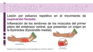 Lesión por esfuerzo repetitivo en el movimiento de
supinación forzada.
Inflamación de los tendones de los músculos del primer
plano del antebrazo ventral, que presentan un origen en
la Epitróclea (Epicóndilo medial).
Pienimäki TT, et al. Widespread pain in chronic epicondylitis. Eur J Pain 2011; 15(9):921-7
 