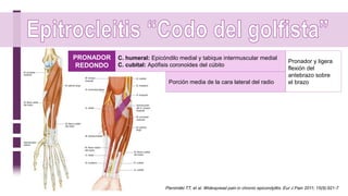 PRONADOR
REDONDO
C. humeral: Epicóndilo medial y tabique intermuscular medial
C. cubital: Apófisis coronoides del cúbito
Porción media de la cara lateral del radio
Pronador y ligera
flexión del
antebrazo sobre
el brazo
Pienimäki TT, et al. Widespread pain in chronic epicondylitis. Eur J Pain 2011; 15(9):921-7
 