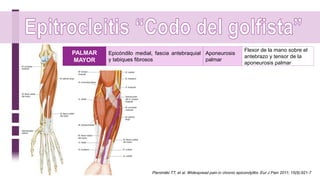 PALMAR
MAYOR
Epicóndilo medial, fascia antebraquial
y tabiques fibrosos
Aponeurosis
palmar
Flexor de la mano sobre el
antebrazo y tensor de la
aponeurosis palmar
Pienimäki TT, et al. Widespread pain in chronic epicondylitis. Eur J Pain 2011; 15(9):921-7
 
