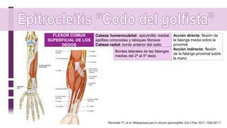 FLEXOR COMUN
SUPERFICIAL DE LOS
DEDOS
Cabeza humerocubital: epicóndilo medial,
apófisis coronoides y tabiques fibrosos
Cabeza radial: borde anterior del radio
Bordes laterales de las falanges
medias del 2º al 5º dedo
Acción directa: flexión de
la falange media sobre la
proximal
Acción indirecta: flexión
de la falange proximal sobre
la mano
Pienimäki TT, et al. Widespread pain in chronic epicondylitis. Eur J Pain 2011; 15(9):921-7
 
