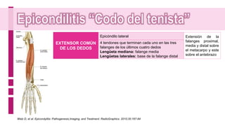 EXTENSOR COMÚN
DE LOS DEDOS
Epicóndilo lateral
4 tendones que terminan cada uno en las tres
falanges de los últimos cuatro dedos
Lengüeta mediana: falange media
Lengüetas laterales: base de la falange distal
Extensión de la
falanges proximal,
media y distal sobre
el metacarpo y este
sobre el antebrazo
Walz D, et al. Epicondylitis: Pathogenesis,Imaging, and Treatment. RadioGraphics. 2010;30:167-84
 