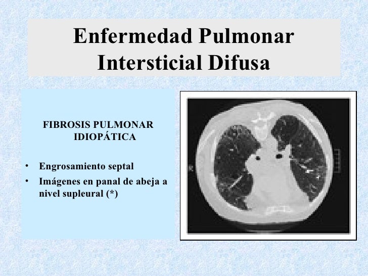 Intersticio Pulmonar Wikipedia La Enciclopedia Libre
