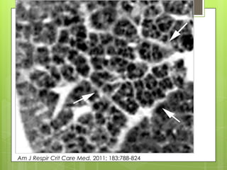 Am J Respir Crit Care Med. 2011; 183:788-824
 