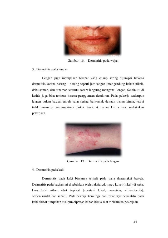 MENGETAHUI HUBUNGAN PENYAKIT DERMATITIS DENGAN 