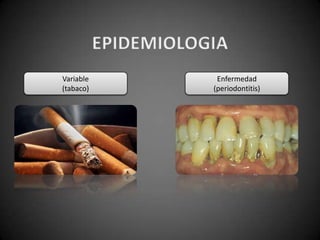 Variable
(tabaco)
Enfermedad
(periodontitis)
 