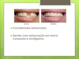  Considerados restaurados:
 Dentes com restauração em resina
composta e amálgama.
 