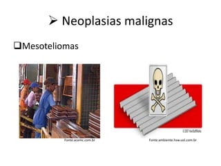  Neoplasias malignas
Mesoteliomas
Fonte:acemc.com.br Fonte:ambiente.hsw.uol.com.br
 