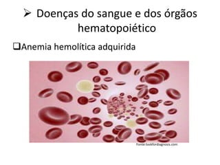  Doenças do sangue e dos órgãos
hematopoiético
Anemia hemolítica adquirida
Fonte:lookfordiagnosis.com
 