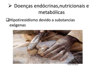  Doenças endócrinas,nutricionais e
metabólicas
Hipotireoidismo devido a substancias
exógenas
Fonte:msf.org.br
 