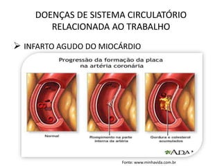 DOENÇAS DE SISTEMA CIRCULATÓRIO
RELACIONADA AO TRABALHO
 INFARTO AGUDO DO MIOCÁRDIO
Fonte: www.minhavida.com.br
 