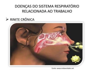 DOENÇAS DO SISTEMA RESPIRATÓRIO
RELACIONADA AO TRABALHO
 RINITE CRÔNICA
Fonte: www.reidaverdade.net
 