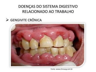 DOENÇAS DO SISTEMA DIGESTIVO
RELACIONADO AO TRABALHO
 GENGIVITE CRÔNICA
Fonte: www.clinicacg.com.br
 