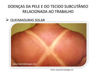 DOENÇAS DA PELE E DO TECIDO SUBCUTÂNEO
RELACIONADA AO TRABALHO
 QUEIMADURAS SOLAR
Fonte: www.dermatologia.net
 