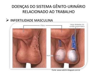DOENÇAS DO SISTEMA GÊNITO-URINÁRIO
RELACIONADO AO TRABALHO
 INFERTILIDADE MASCULINA
Fonte: www.radiclin.blogspot.com.br
 