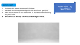 CONCLUSION
1. Poliomyelitis is an acute enteroviral illness.
2. The most devastating result of poliovirus infection is ‘paralysis’.
3. This disease results in the destruction of motor neurons caused by
the polio virus
4. Vaccination is the only effective method of prevention.
World Polio Day
24 OCTOBER
 