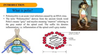INTRODUCTION
What is polio?
• Poliomyelitis is an acute viral infection caused by an RNA virus.
• The term “Poliomyelitis” derives from the ancient Greek word
Polio’s means “grey” and myelos meaning “marrow” referring to
the grey matter of the spinal cord. The suffix itis denotes
inflammation, i.e. inflammation of the spinal cord’s grey matter.
 