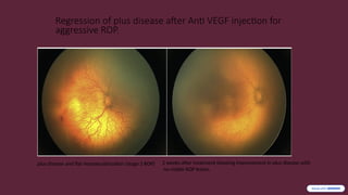 Agressive Rop Epidemiology-and-Disease-Burden-of-ROP-in-India.pptx