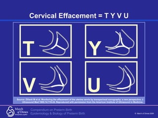 Compendium on Preterm Birth
© March of Dimes 2006
Epidemiology & Biology of Preterm Birth
Cervical Effacement = T Y V U
So...