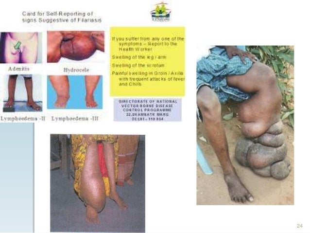 1g paracetamol filariasis (Lymphatic Epidemiology and of control