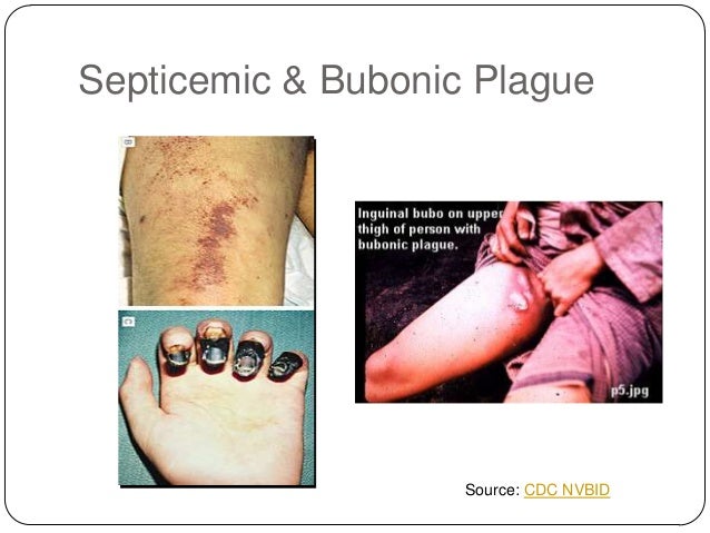 fever control how plague and prevention of Epidemiology