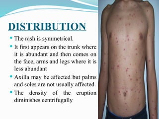 Epidemiology of Chicken pox.pptx................... | PPTX