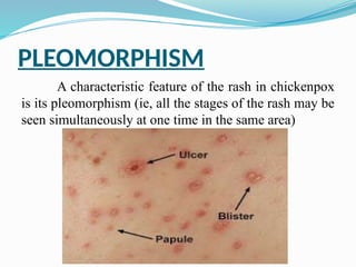 Epidemiology of Chicken pox.pptx................... | PPTX