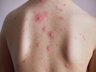epidemiology of common infectious diseases-resp,git,arthropod.pptx