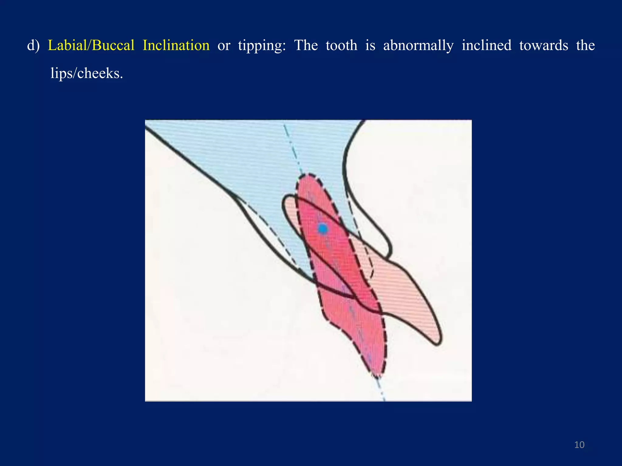 d) Labial/Buccal Inclination or tipping: The tooth is abnormally inclined towards the
lips/cheeks.
10
 