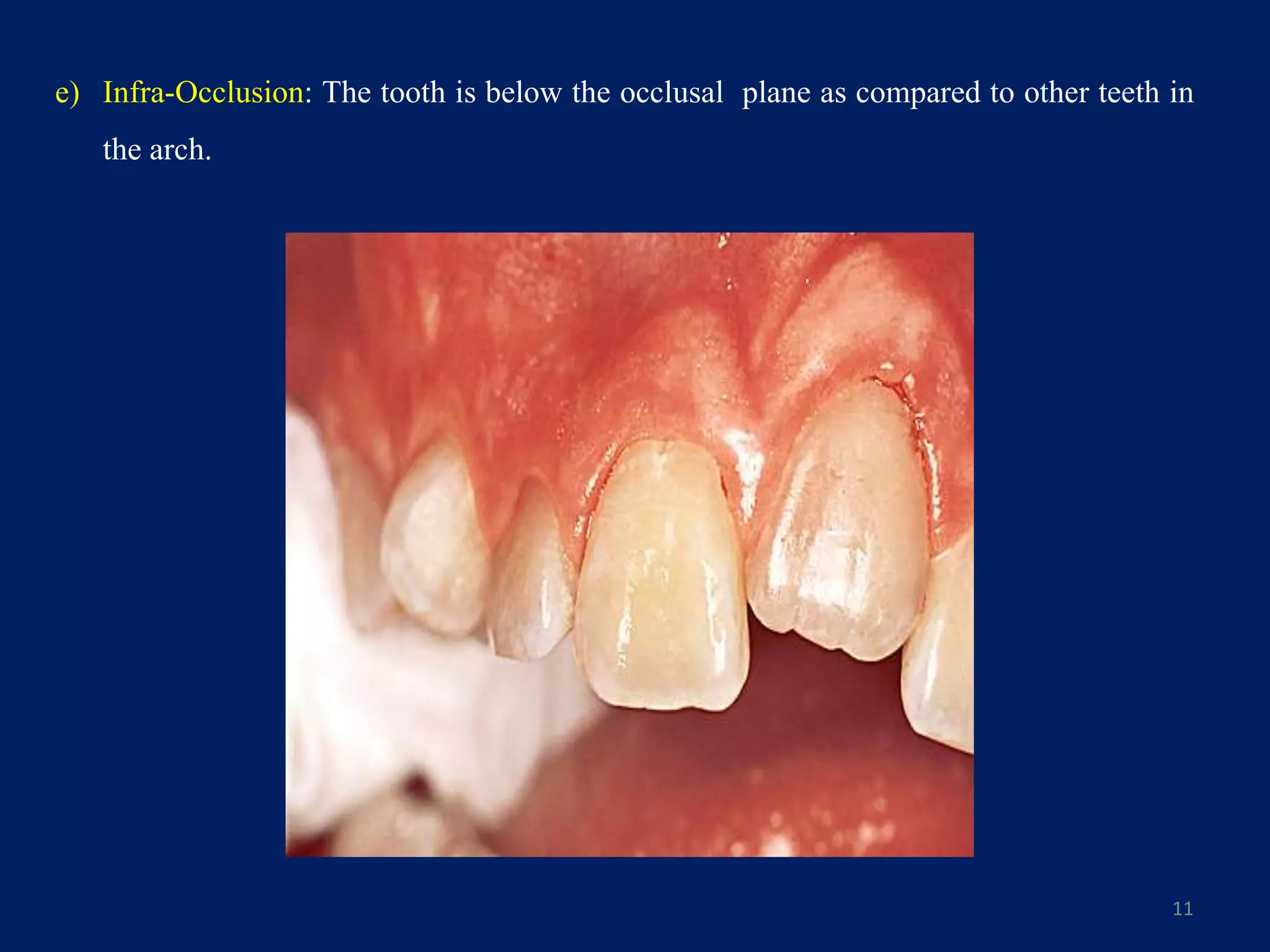 e) Infra-Occlusion: The tooth is below the occlusal plane as compared to other teeth in
the arch.
11
 