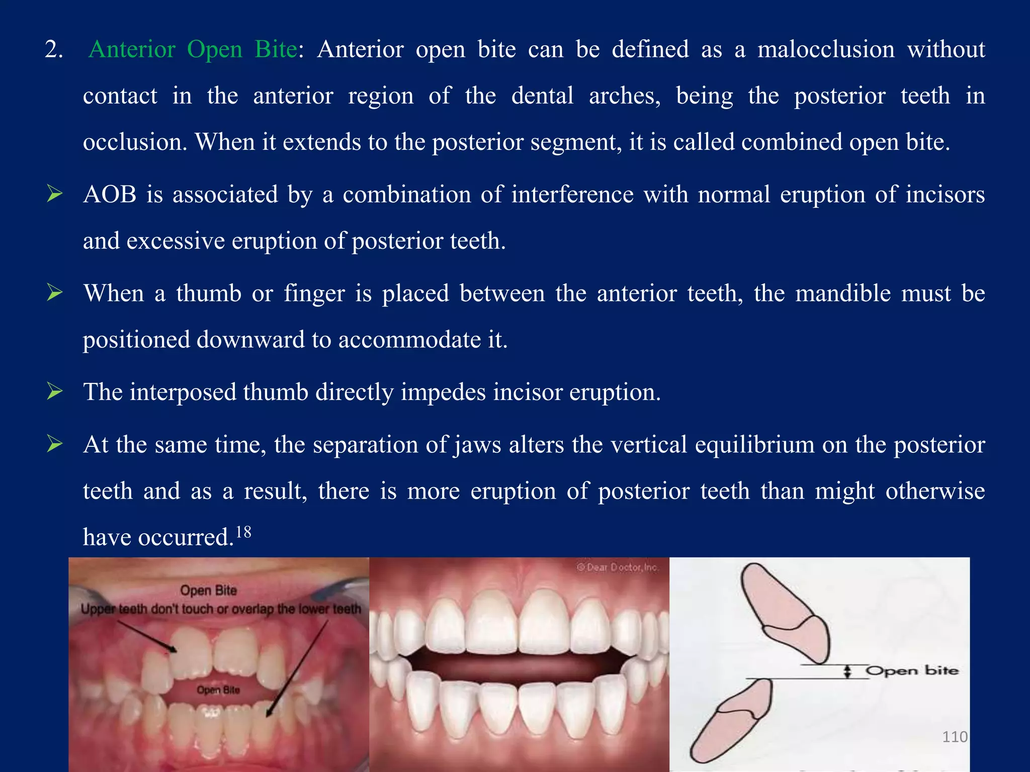 2. Anterior Open Bite: Anterior open bite can be defined as a malocclusion without
contact in the anterior region of the dental arches, being the posterior teeth in
occlusion. When it extends to the posterior segment, it is called combined open bite.
 AOB is associated by a combination of interference with normal eruption of incisors
and excessive eruption of posterior teeth.
 When a thumb or finger is placed between the anterior teeth, the mandible must be
positioned downward to accommodate it.
 The interposed thumb directly impedes incisor eruption.
 At the same time, the separation of jaws alters the vertical equilibrium on the posterior
teeth and as a result, there is more eruption of posterior teeth than might otherwise
have occurred.18
110
 