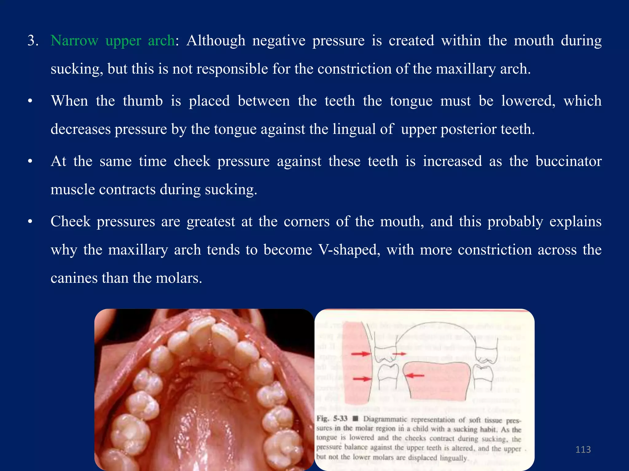 3. Narrow upper arch: Although negative pressure is created within the mouth during
sucking, but this is not responsible for the constriction of the maxillary arch.
• When the thumb is placed between the teeth the tongue must be lowered, which
decreases pressure by the tongue against the lingual of upper posterior teeth.
• At the same time cheek pressure against these teeth is increased as the buccinator
muscle contracts during sucking.
• Cheek pressures are greatest at the corners of the mouth, and this probably explains
why the maxillary arch tends to become V-shaped, with more constriction across the
canines than the molars.
113
 
