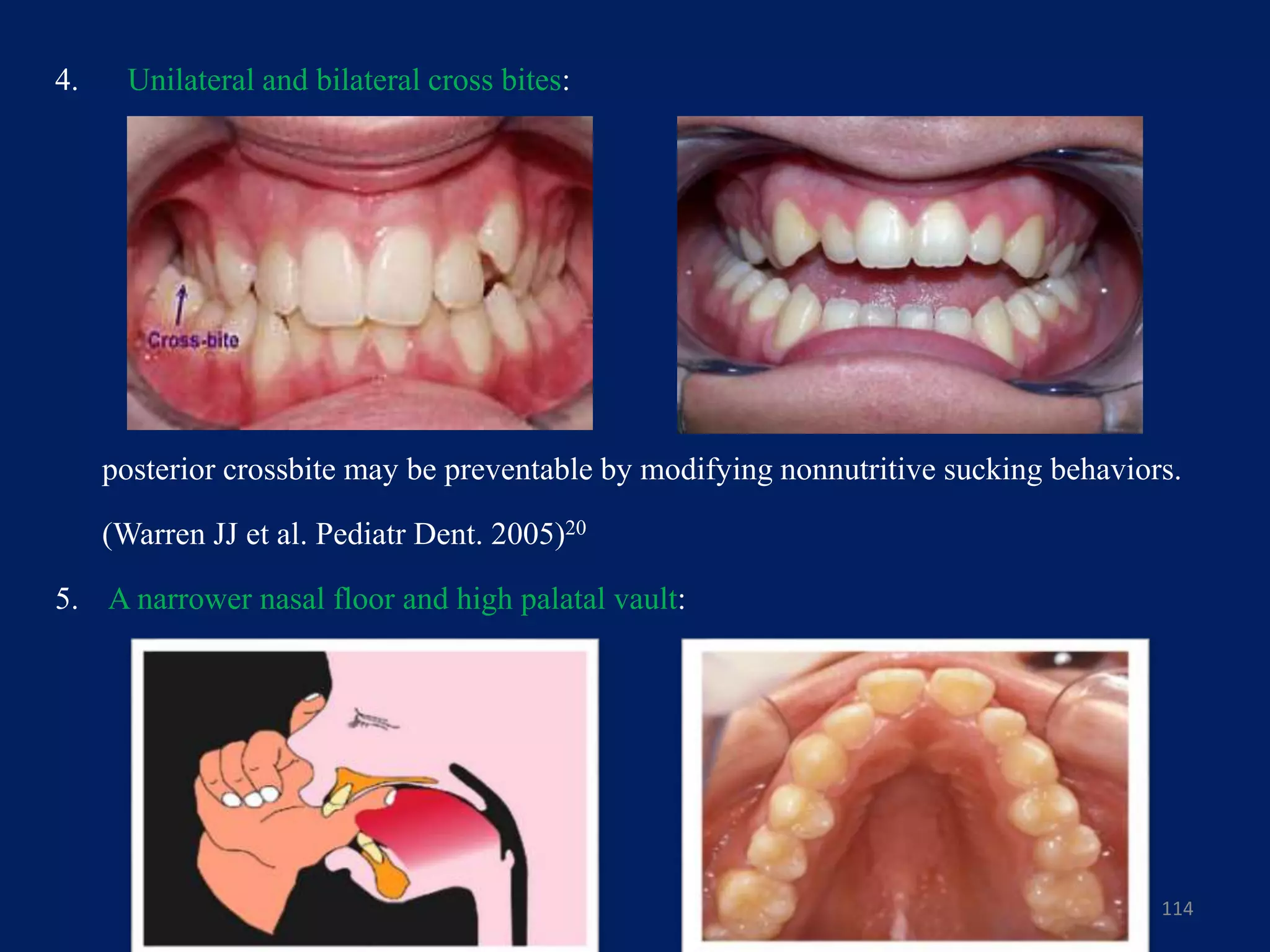 4. Unilateral and bilateral cross bites:
posterior crossbite may be preventable by modifying nonnutritive sucking behaviors.
(Warren JJ et al. Pediatr Dent. 2005)20
5. A narrower nasal floor and high palatal vault:
114
 