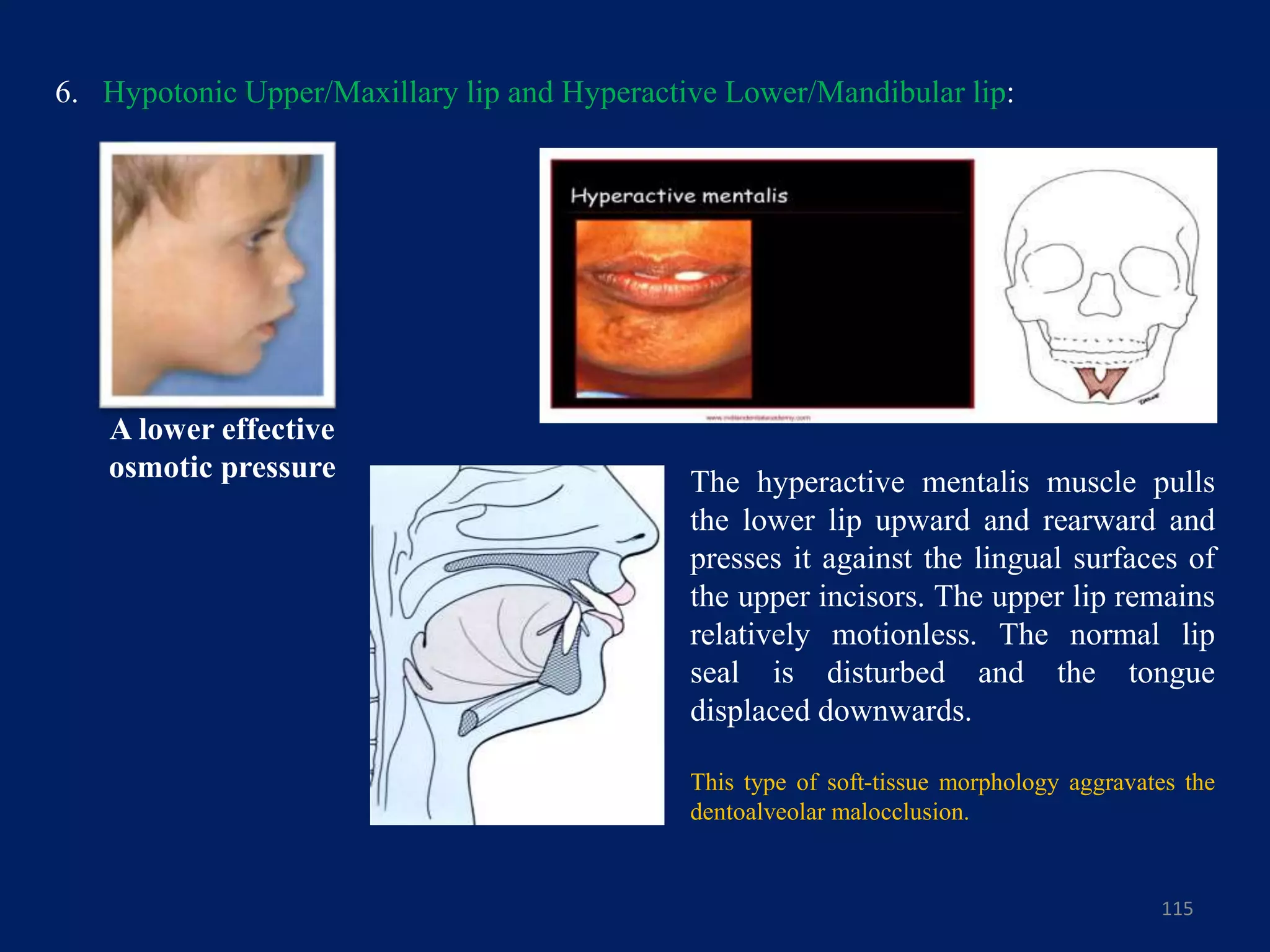 6. Hypotonic Upper/Maxillary lip and Hyperactive Lower/Mandibular lip:
115
The hyperactive mentalis muscle pulls
the lower lip upward and rearward and
presses it against the lingual surfaces of
the upper incisors. The upper lip remains
relatively motionless. The normal lip
seal is disturbed and the tongue
displaced downwards.
This type of soft-tissue morphology aggravates the
dentoalveolar malocclusion.
A lower effective
osmotic pressure
 