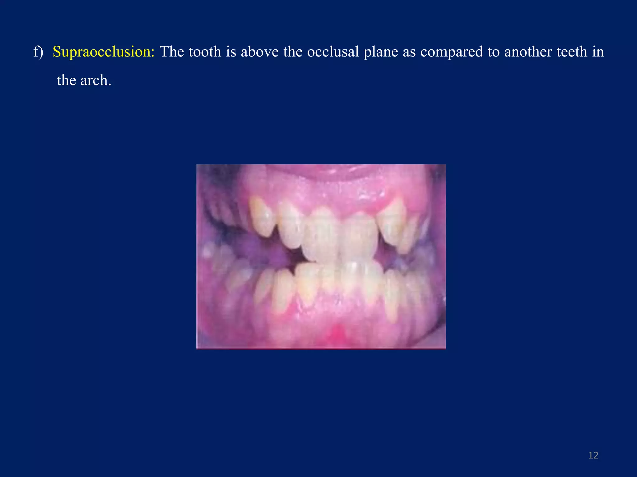 f) Supraocclusion: The tooth is above the occlusal plane as compared to another teeth in
the arch.
12
 