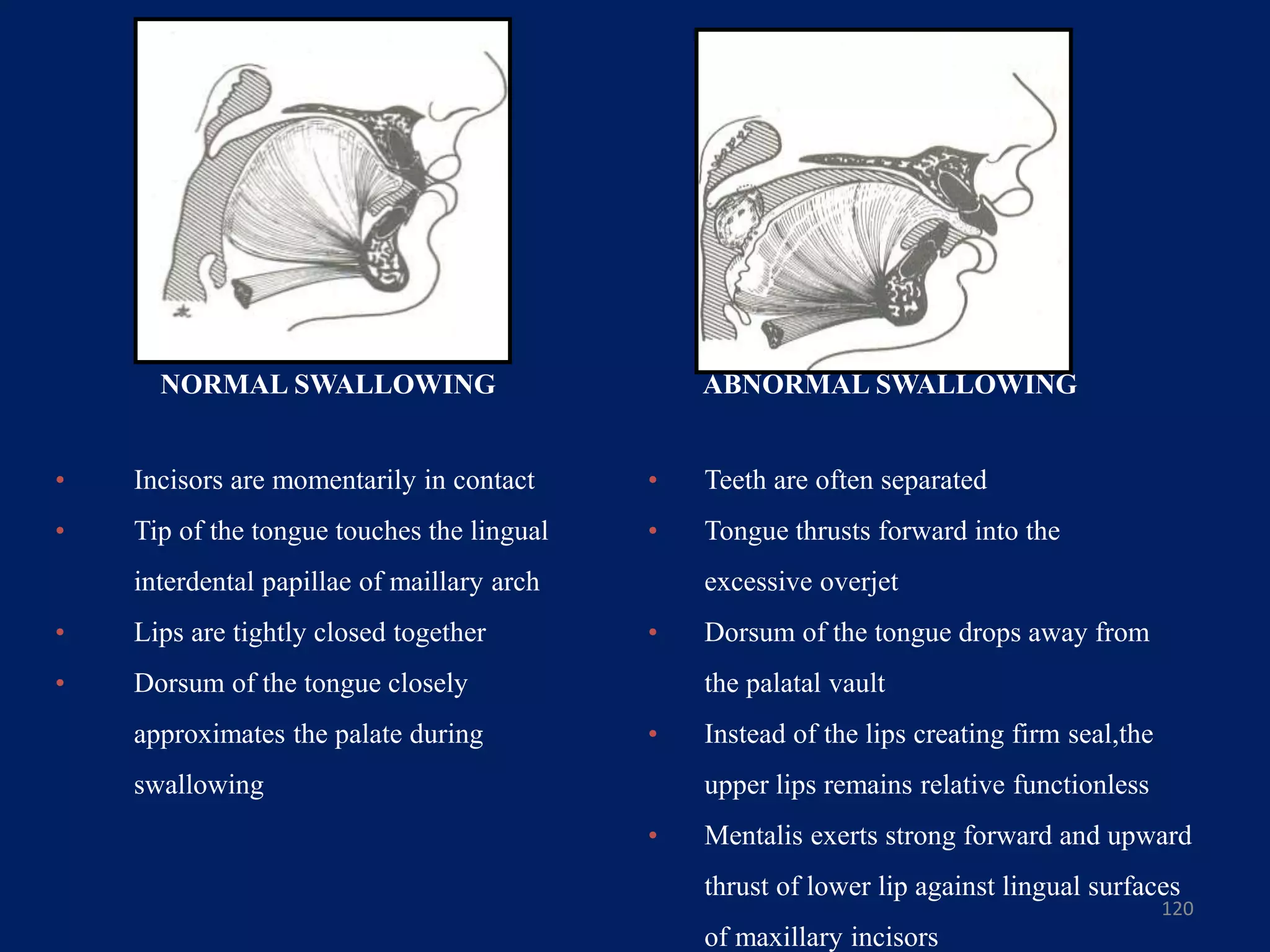 120
NORMAL SWALLOWING
• Incisors are momentarily in contact
• Tip of the tongue touches the lingual
interdental papillae of maillary arch
• Lips are tightly closed together
• Dorsum of the tongue closely
approximates the palate during
swallowing
ABNORMAL SWALLOWING
• Teeth are often separated
• Tongue thrusts forward into the
excessive overjet
• Dorsum of the tongue drops away from
the palatal vault
• Instead of the lips creating firm seal,the
upper lips remains relative functionless
• Mentalis exerts strong forward and upward
thrust of lower lip against lingual surfaces
of maxillary incisors
 