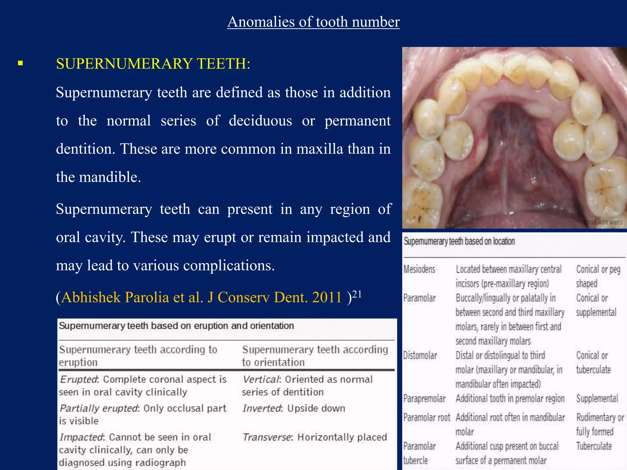 Anomalies of tooth number
 SUPERNUMERARY TEETH:
Supernumerary teeth are defined as those in addition
to the normal series of deciduous or permanent
dentition. These are more common in maxilla than in
the mandible.
Supernumerary teeth can present in any region of
oral cavity. These may erupt or remain impacted and
may lead to various complications.
(Abhishek Parolia et al. J Conserv Dent. 2011 )21
125
 