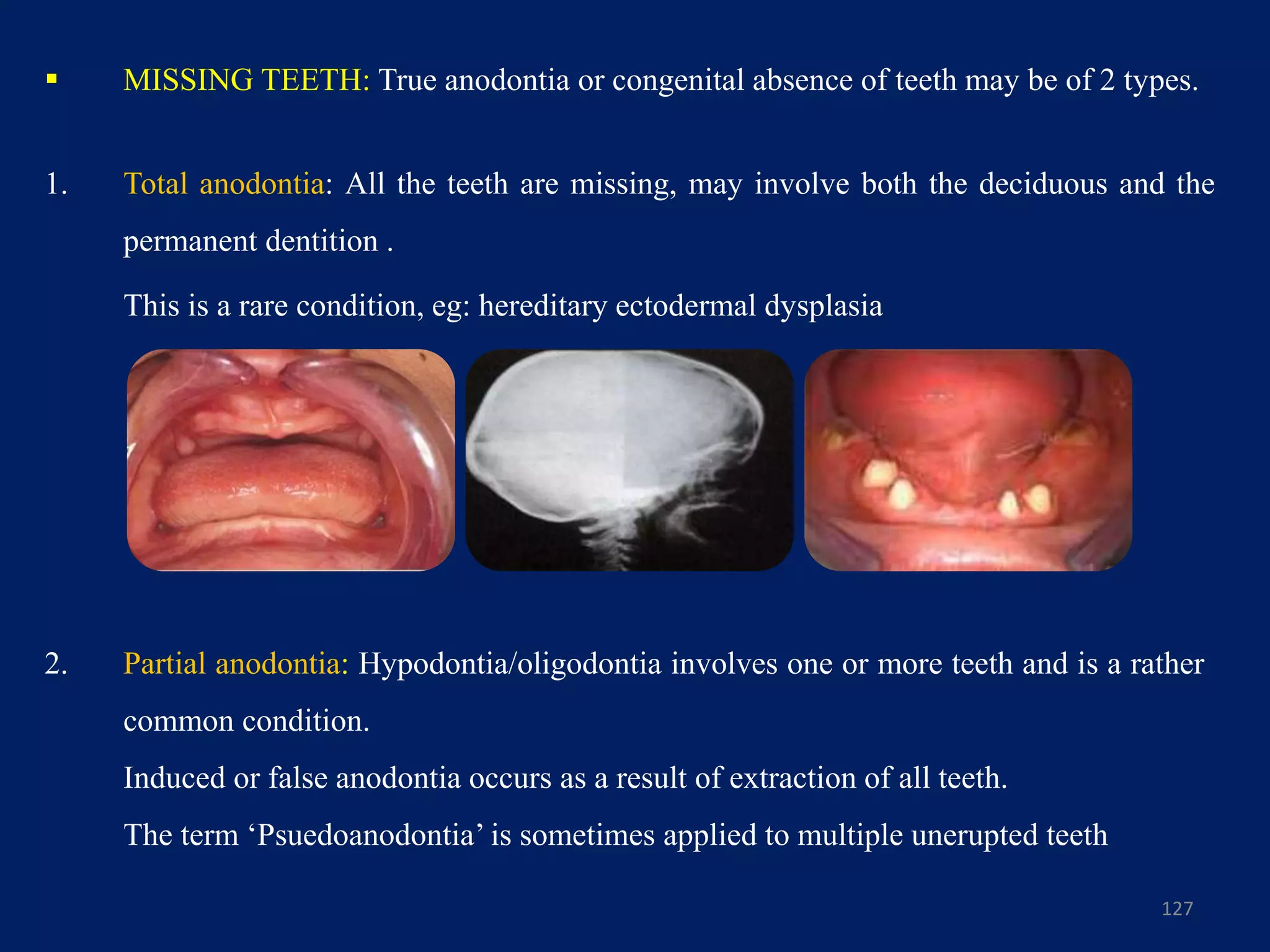 127
 MISSING TEETH: True anodontia or congenital absence of teeth may be of 2 types.
1. Total anodontia: All the teeth are missing, may involve both the deciduous and the
permanent dentition .
This is a rare condition, eg: hereditary ectodermal dysplasia
2. Partial anodontia: Hypodontia/oligodontia involves one or more teeth and is a rather
common condition.
Induced or false anodontia occurs as a result of extraction of all teeth.
The term ‘Psuedoanodontia’ is sometimes applied to multiple unerupted teeth
 
