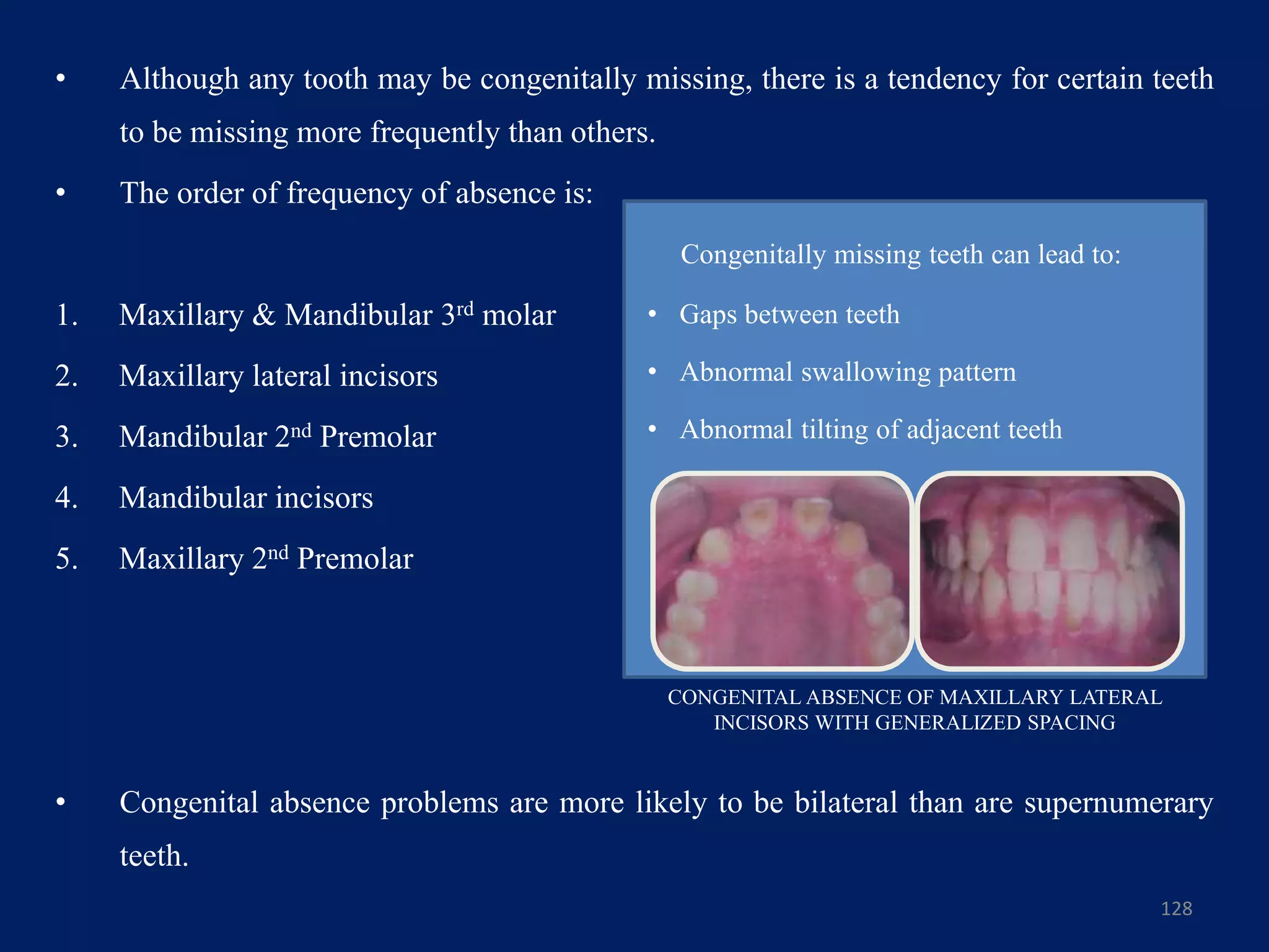 • Although any tooth may be congenitally missing, there is a tendency for certain teeth
to be missing more frequently than others.
• The order of frequency of absence is:
1. Maxillary & Mandibular 3rd molar
2. Maxillary lateral incisors
3. Mandibular 2nd Premolar
4. Mandibular incisors
5. Maxillary 2nd Premolar
• Congenital absence problems are more likely to be bilateral than are supernumerary
teeth.
128
Congenitally missing teeth can lead to:
• Gaps between teeth
• Abnormal swallowing pattern
• Abnormal tilting of adjacent teeth
CONGENITAL ABSENCE OF MAXILLARY LATERAL
INCISORS WITH GENERALIZED SPACING
 