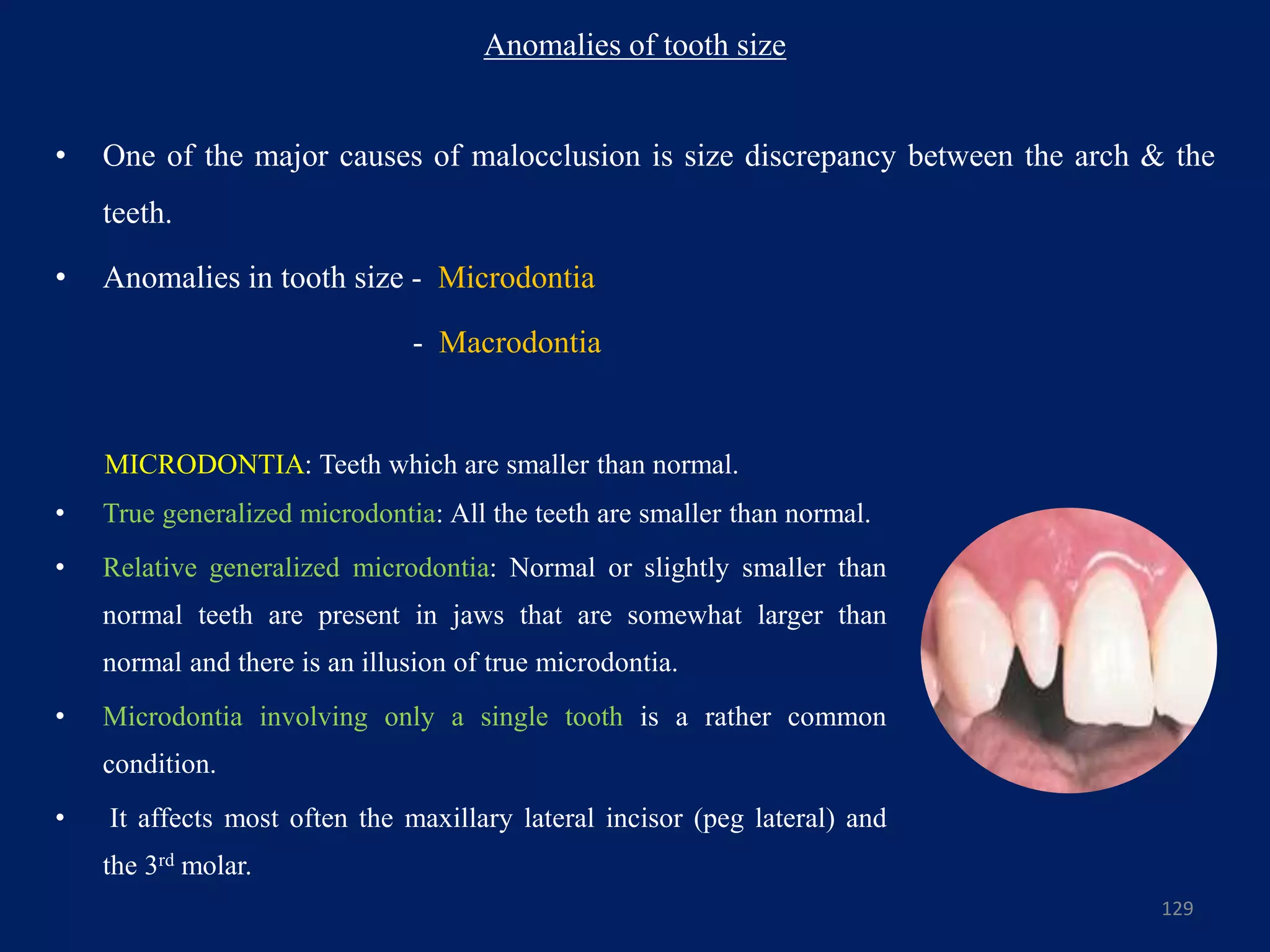 Anomalies of tooth size
129
• One of the major causes of malocclusion is size discrepancy between the arch & the
teeth.
• Anomalies in tooth size - Microdontia
- Macrodontia
MICRODONTIA: Teeth which are smaller than normal.
• True generalized microdontia: All the teeth are smaller than normal.
• Relative generalized microdontia: Normal or slightly smaller than
normal teeth are present in jaws that are somewhat larger than
normal and there is an illusion of true microdontia.
• Microdontia involving only a single tooth is a rather common
condition.
• It affects most often the maxillary lateral incisor (peg lateral) and
the 3rd molar.
 