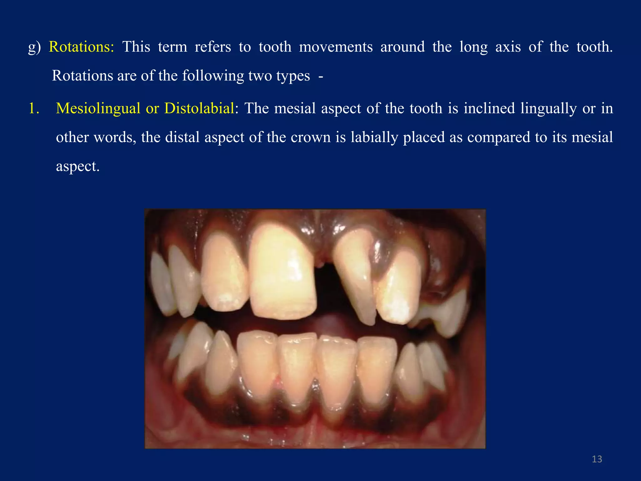 g) Rotations: This term refers to tooth movements around the long axis of the tooth.
Rotations are of the following two types -
1. Mesiolingual or Distolabial: The mesial aspect of the tooth is inclined lingually or in
other words, the distal aspect of the crown is labially placed as compared to its mesial
aspect.
13
 