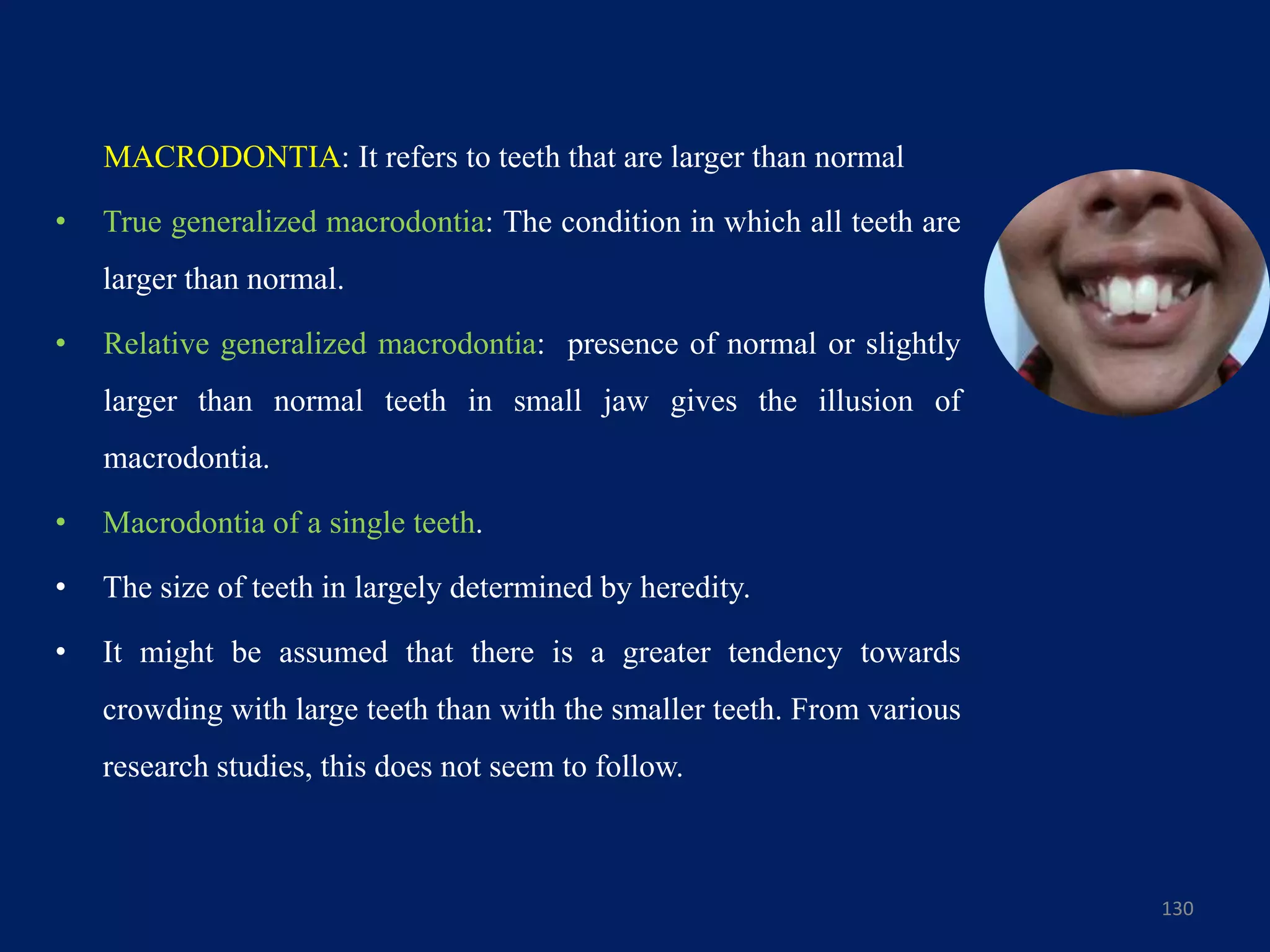 130
MACRODONTIA: It refers to teeth that are larger than normal
• True generalized macrodontia: The condition in which all teeth are
larger than normal.
• Relative generalized macrodontia: presence of normal or slightly
larger than normal teeth in small jaw gives the illusion of
macrodontia.
• Macrodontia of a single teeth.
• The size of teeth in largely determined by heredity.
• It might be assumed that there is a greater tendency towards
crowding with large teeth than with the smaller teeth. From various
research studies, this does not seem to follow.
 