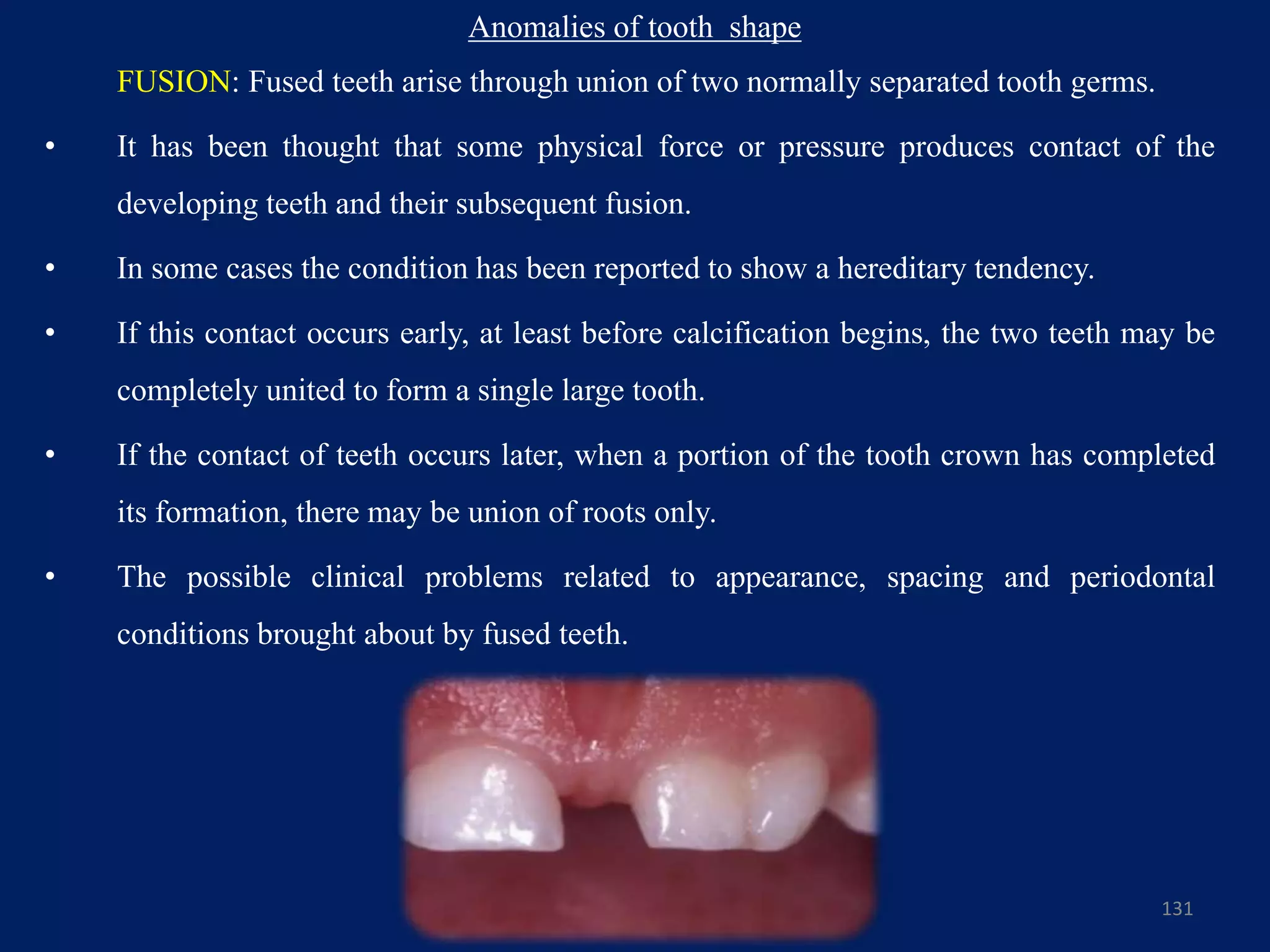 131
FUSION: Fused teeth arise through union of two normally separated tooth germs.
• It has been thought that some physical force or pressure produces contact of the
developing teeth and their subsequent fusion.
• In some cases the condition has been reported to show a hereditary tendency.
• If this contact occurs early, at least before calcification begins, the two teeth may be
completely united to form a single large tooth.
• If the contact of teeth occurs later, when a portion of the tooth crown has completed
its formation, there may be union of roots only.
• The possible clinical problems related to appearance, spacing and periodontal
conditions brought about by fused teeth.
Anomalies of tooth shape
 